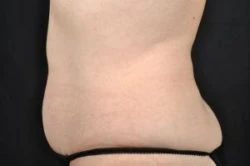 CoolSculpting
