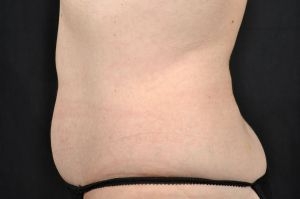 CoolSculpting