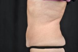 CoolSculpting