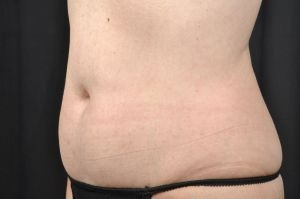 CoolSculpting