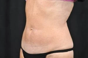 CoolSculpting