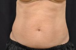 CoolSculpting