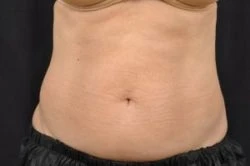 CoolSculpting