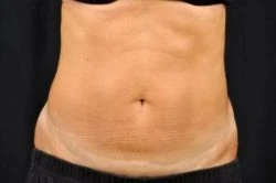 CoolSculpting