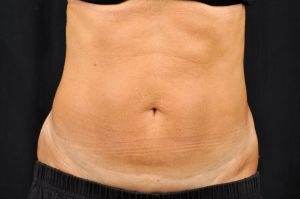 CoolSculpting