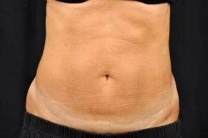 CoolSculpting