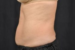 CoolSculpting