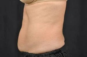 CoolSculpting