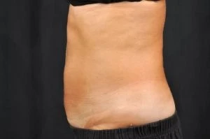 CoolSculpting
