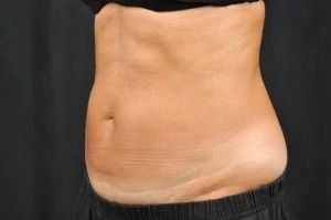 CoolSculpting