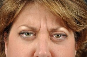 Botox Cosmetic before photo