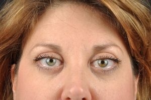 Botox Cosmetic after photo