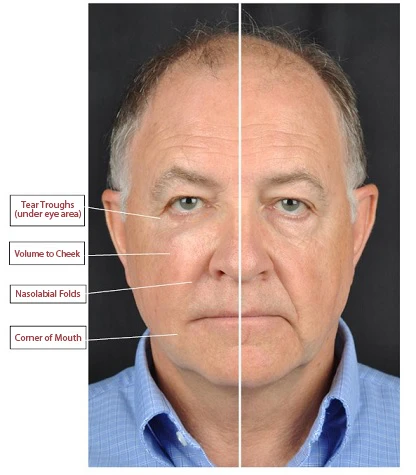 Dermal Fillers Virginia Beach